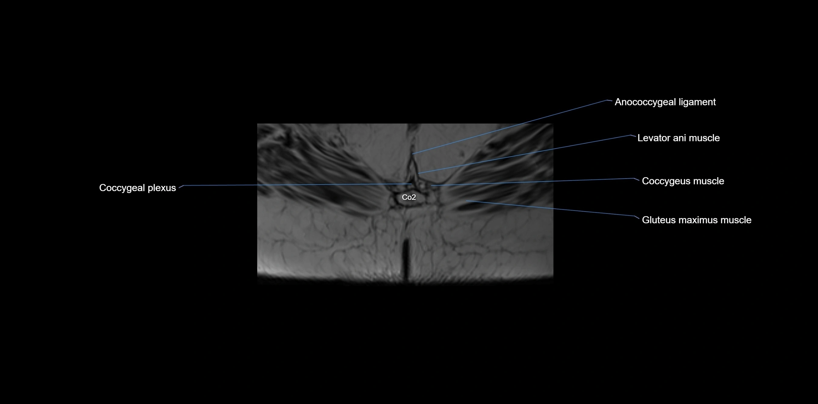 MRI sacrum, coccyx and sacroiliac joint axial cross sectional anatomy 3T  radiology  image-img-00001-00076.webp